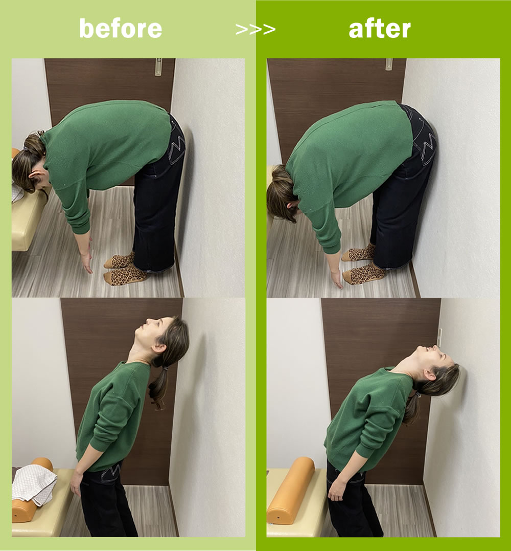 やわらぎBODYコンディショニング鍼灸整骨院の鍼灸治療のビフォーアフター