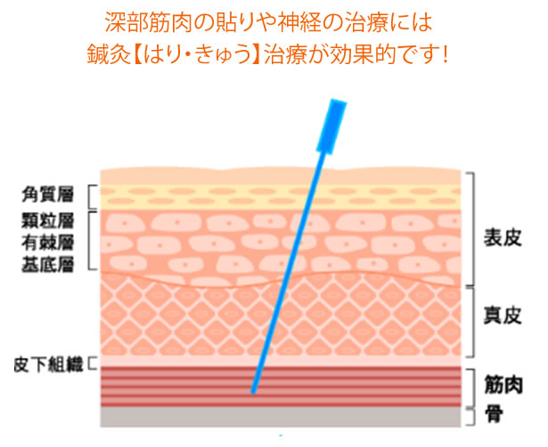 やわらぎBODYコンディショニング鍼灸整骨院の鍼灸治療