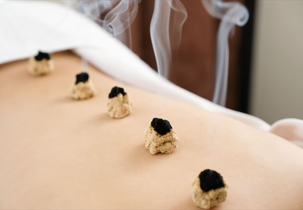 やわらぎBODYコンディショニング鍼灸整骨院のお灸治療