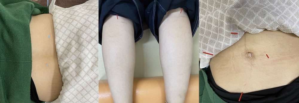 やわらぎBODYコンディショニング鍼灸整骨院の鍼灸治療