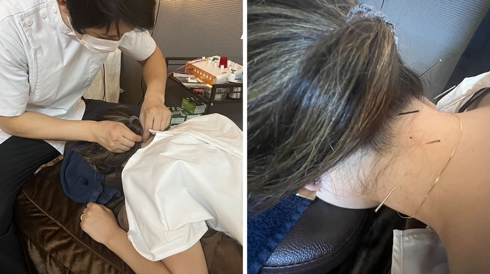 やわらぎBODYコンディショニング鍼灸整骨院の鍼灸治療