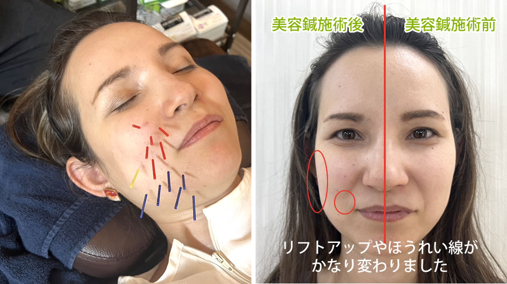 やわらぎBODYコンディショニング鍼灸整骨院の美容鍼灸治療