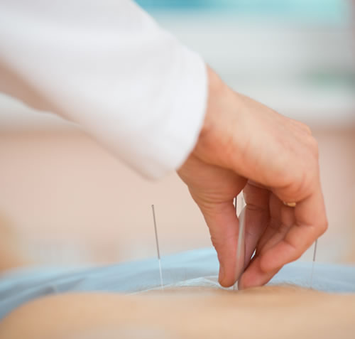 鍼灸イメージ